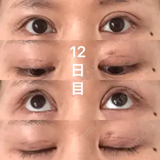 11日目の経過画像（1枚目）