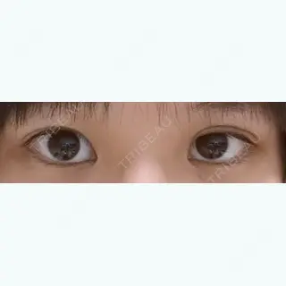 11日目の経過画像（1枚目）