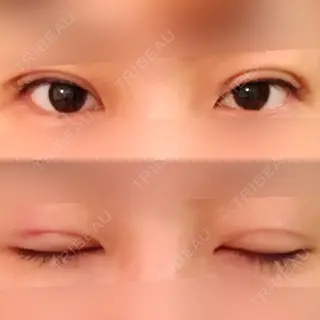 15日目の経過画像（1枚目）