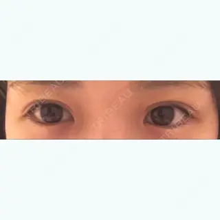 0日目の経過画像（1枚目）