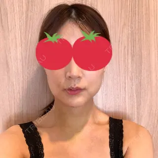 4日目の経過画像（1枚目）