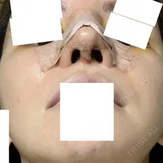 4日目の経過画像（3枚目）