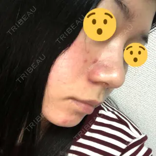 7日目の経過画像（2枚目）