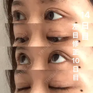13日目の経過画像（3枚目）
