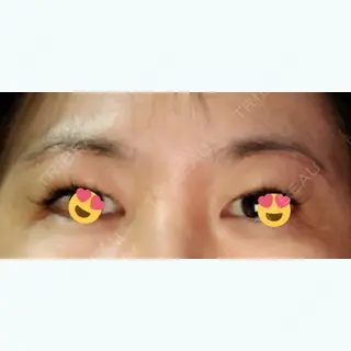 41日目の経過画像（3枚目）