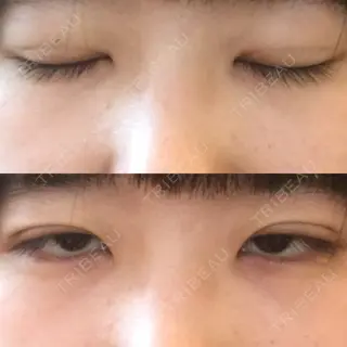 4日目の経過画像（1枚目）