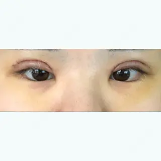 6日目の経過画像（1枚目）