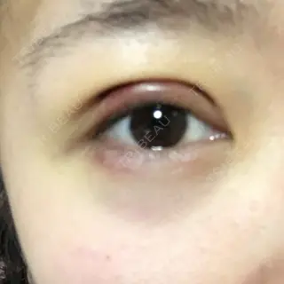 3日目の経過画像（1枚目）