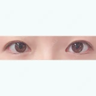 32日目の経過画像（1枚目）