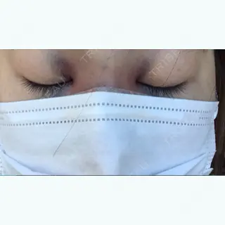 1日目の経過画像（1枚目）