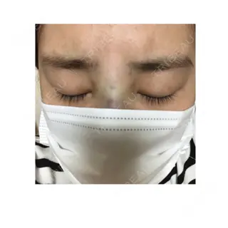 0日目の経過画像（1枚目）