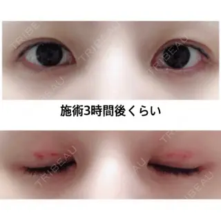 0日目の経過画像（2枚目）