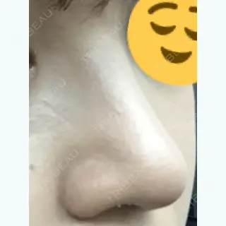 32日目の経過画像（2枚目）