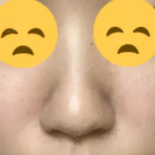 7日目の経過画像（1枚目）