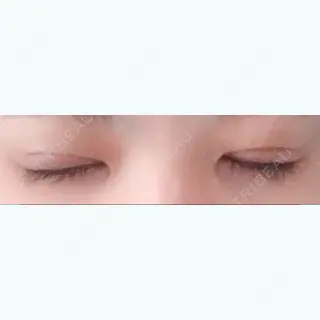 14日目の経過画像（2枚目）