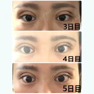 4日目の経過画像（1枚目）