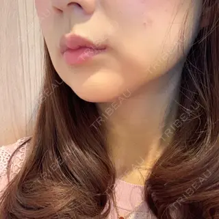 7日目の経過画像（1枚目）