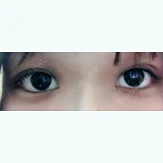 0日目の経過画像（1枚目）