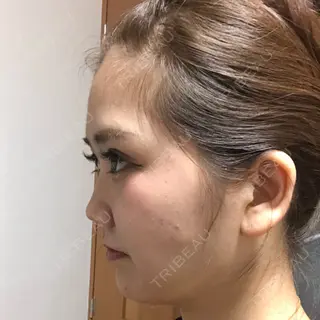 13日目の経過画像（3枚目）