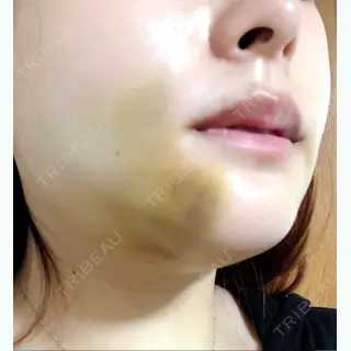 4日目の経過画像（2枚目）