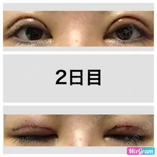 2日目の経過画像（1枚目）