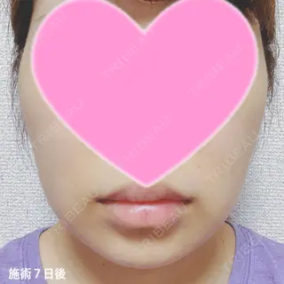7日目の経過画像（1枚目）