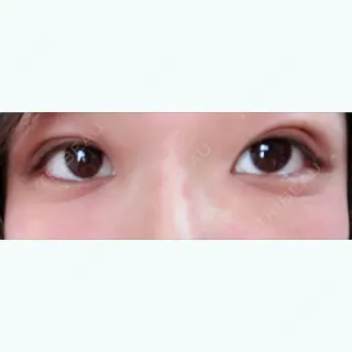 2日目の経過画像（1枚目）
