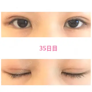35日目の経過画像（1枚目）