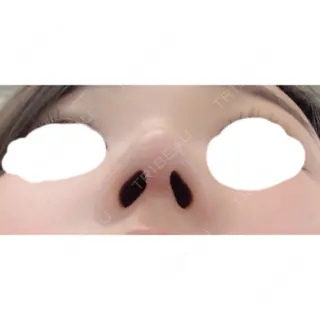 34日目の経過画像（3枚目）