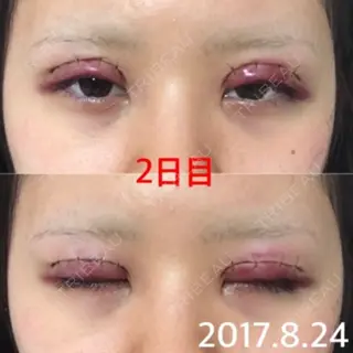 1日目の経過画像（1枚目）