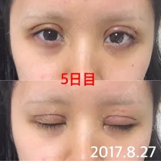 4日目の経過画像（1枚目）