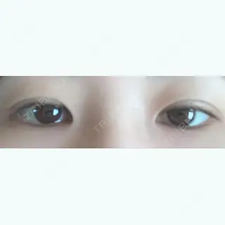 49日目の経過画像（1枚目）