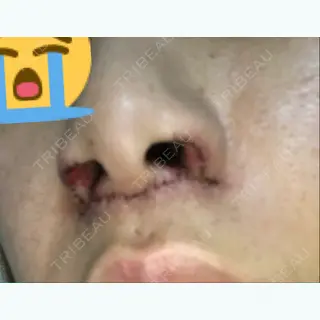 5日目の経過画像（3枚目）