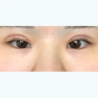11日目の経過画像（1枚目）