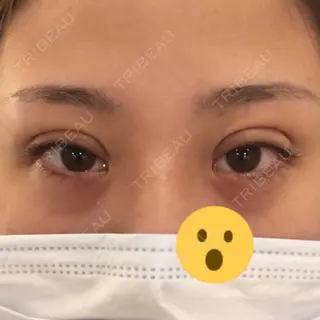0日目の経過画像（2枚目）