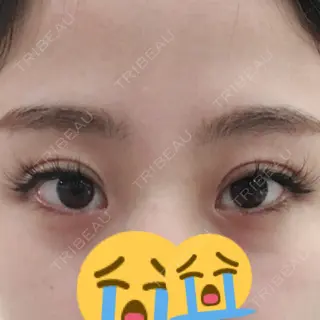 92日目の経過画像（1枚目）