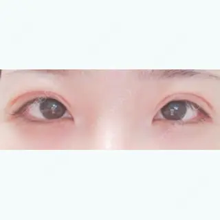 12日目の経過画像（1枚目）