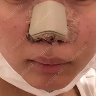 1日目の経過画像（1枚目）
