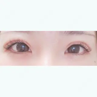 13日目の経過画像（1枚目）