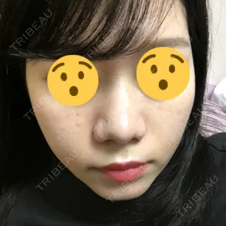 15日目の経過画像（1枚目）