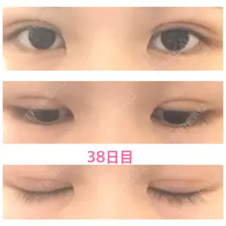 38日目の経過画像（1枚目）