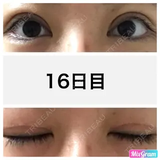 16日目の経過画像（1枚目）