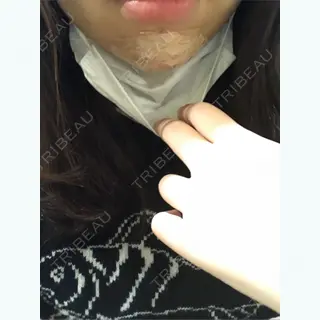 0日目の経過画像（1枚目）