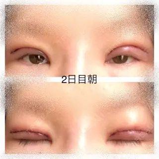 2日目の経過画像（1枚目）