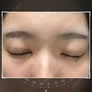 26日目の経過画像（2枚目）