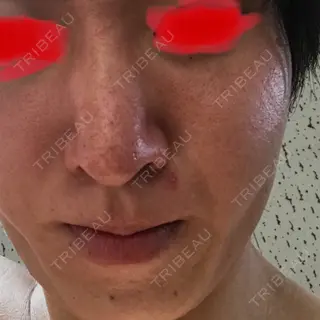 34日目の経過画像（1枚目）
