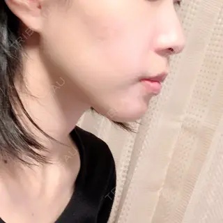 80日目の経過画像（2枚目）
