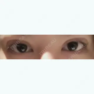 0日目の経過画像（1枚目）