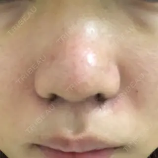 5日目の経過画像（1枚目）