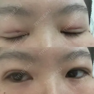 1日目の経過画像（1枚目）